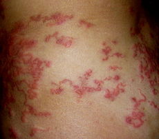 hookworm