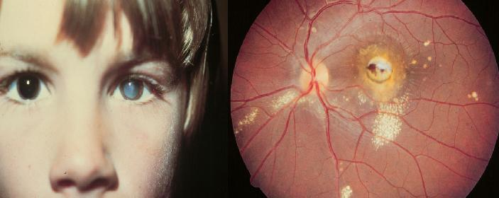 roundworm